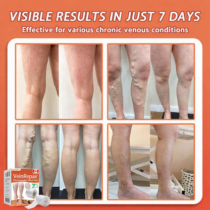 🍁 ✨Final Hours! Save 75% on Celsiora® Vein Ease Microneedle Care Patch(For Spider Veins, Varicose Veins, Swelling & Leg Fatigue)