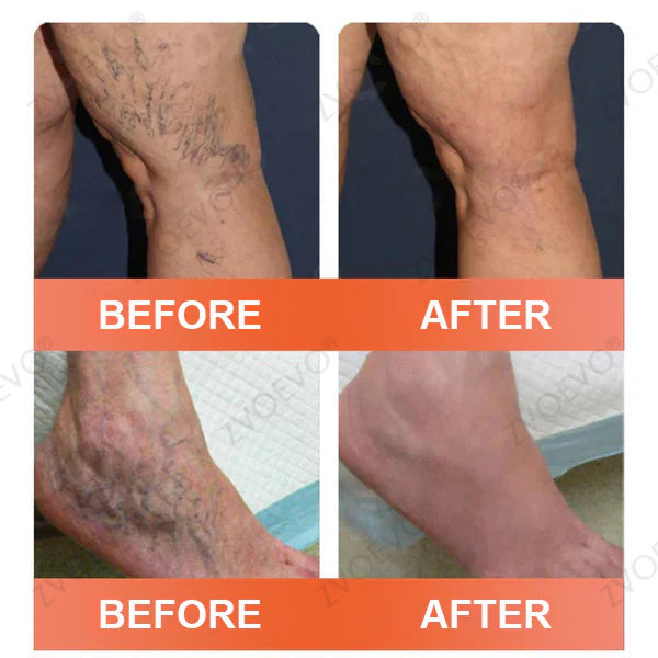 🍁 ✨Final Hours! Save 75% on Celsiora® Vein Ease Microneedle Care Patch(For Spider Veins, Varicose Veins, Swelling & Leg Fatigue)