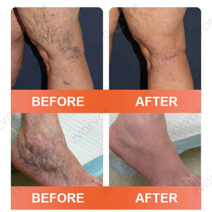 🍁 ✨Final Hours! Save 75% on Celsiora® Vein Ease Microneedle Care Patch(For Spider Veins, Varicose Veins, Swelling & Leg Fatigue)