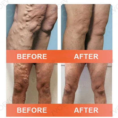 🍁 ✨Final Hours! Save 75% on Celsiora® Vein Ease Microneedle Care Patch(For Spider Veins, Varicose Veins, Swelling & Leg Fatigue)